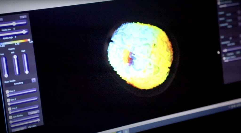 Display showing qEEG brain image