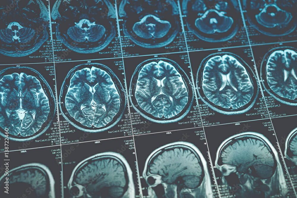 Brain Scan Showing Gray Matter