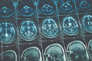 Brain scans can be ordered in the treatment for concussions