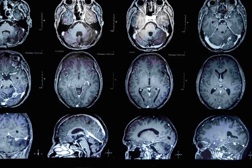 Feeding the Brain: The Role of Metabolic and Nutritional Therapy in ...